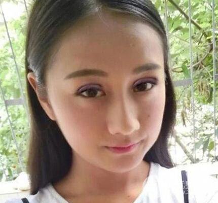 北京伊美爾何禎平做完雙眼皮