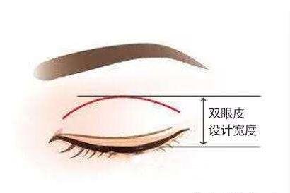 雙眼皮