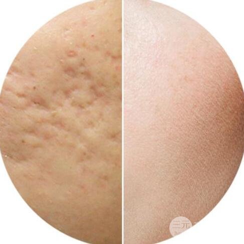 激光緩解痘疤有嗎