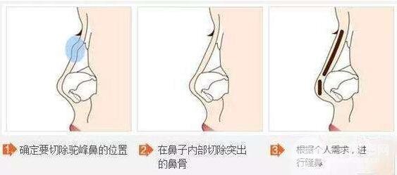 駝峰鼻矯正有什么方式?