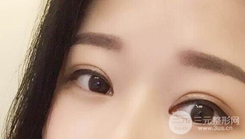 全割雙眼皮后的注意事項(xiàng)