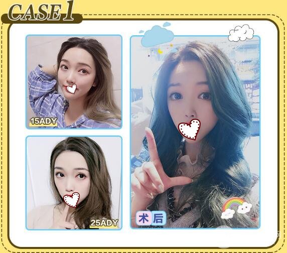 定點(diǎn)雙眼皮多少錢(qián) 可以保持多久？