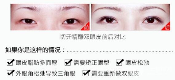 切開雙眼皮一般多少錢 哪些適合