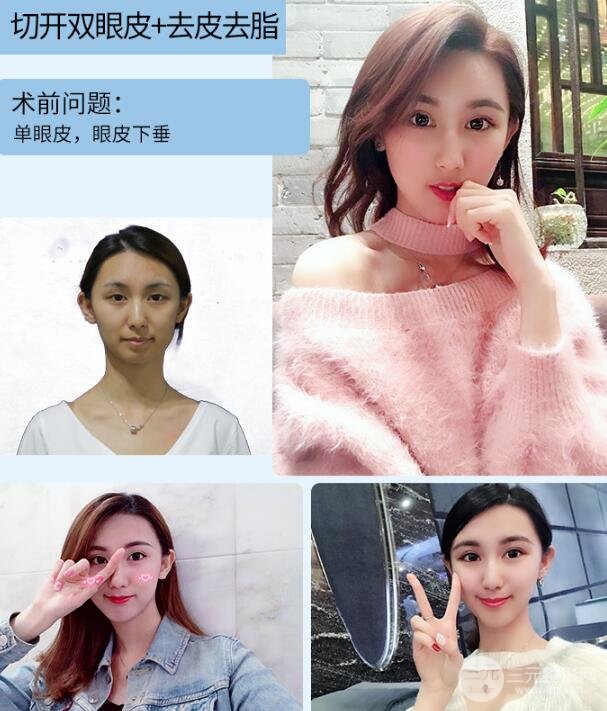 切開雙眼皮一般多少錢 果好不好 案例圖