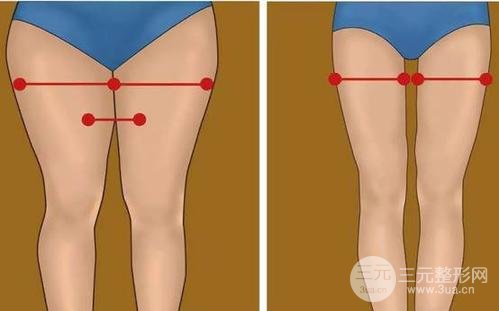 吸脂瘦大腿腫脹期是多久？多久能看到果？