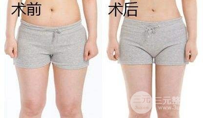 吸脂瘦大腿腫脹期是多久？多久能看到果？