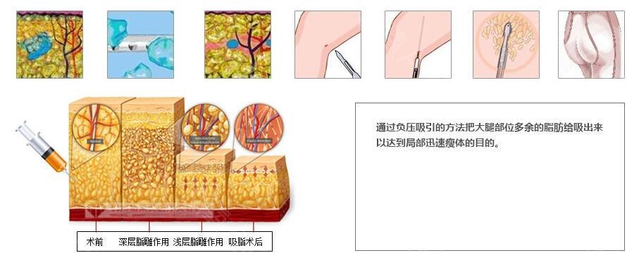 吸脂瘦大腿腫脹期是多久？多久能看到果？