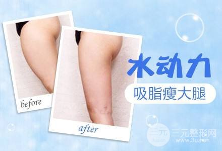 吸脂瘦大腿腫脹期是多久？多久能看到果？
