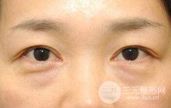 去眼袋手術(shù)有什么風(fēng)險(xiǎn)?