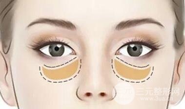 去眼袋手術(shù)有什么風(fēng)險(xiǎn)?