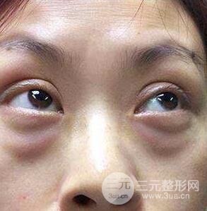 去眼袋手術(shù)有什么風(fēng)險(xiǎn)?