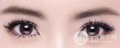 雙眼皮修復(fù)恢復(fù)期多久？具體的恢復(fù)時(shí)間揭秘~