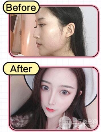 隆鼻失敗修復(fù)手術(shù)果好不好 案例圖