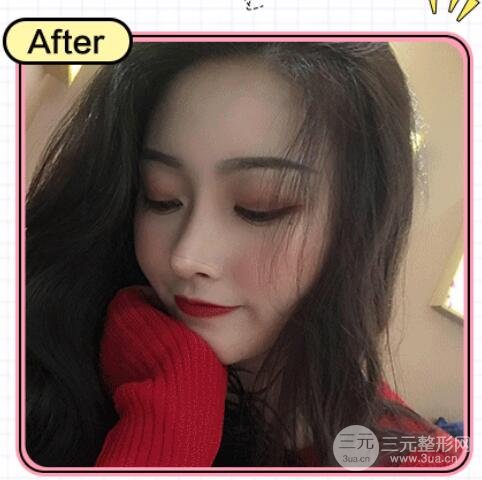 隆鼻失敗修復(fù)手術(shù)案例圖 術(shù)后果