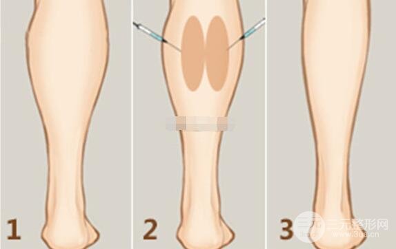 ****瘦腿價格貴不貴？一般多少錢？