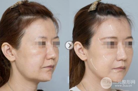 聲刀美容的副作用