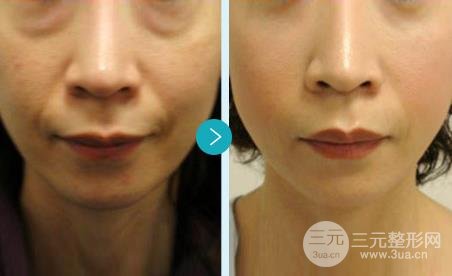 聲刀美容的副作用