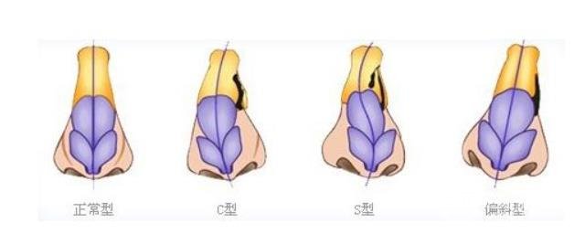 做取隆鼻假體修復(fù)術(shù)的補(bǔ)救措施，如何再次擁有美鼻