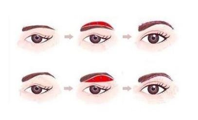 切眉術(shù)會留下疤痕嗎?