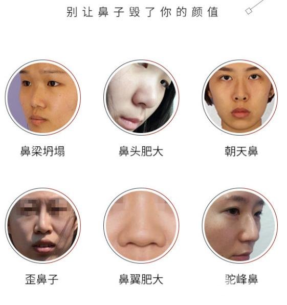 膨體隆鼻預(yù)防變形的方法