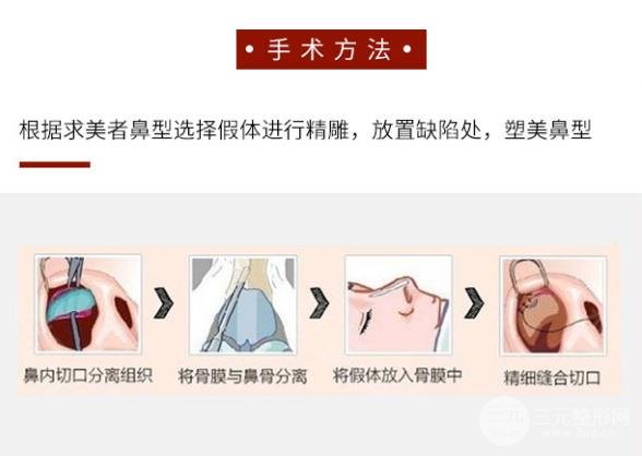 膨體隆鼻預(yù)防變形的方法