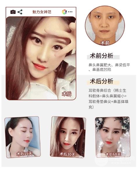 在飲食上預(yù)防膨體隆鼻變形的方法