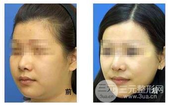 面部吸脂的危害