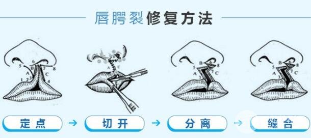 科普：兔唇手術(shù)多少錢？