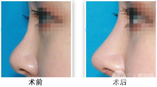 假體隆鼻注意事項有哪些呢？趕緊來科普一下吧~