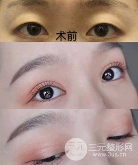 割雙眼皮對(duì)比圖，光看這些圖片就能感受到手術(shù)的優(yōu)勢(shì)