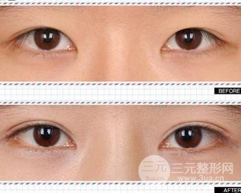 割雙眼皮對(duì)比圖，光看這些圖片就能感受到手術(shù)的優(yōu)勢(shì)