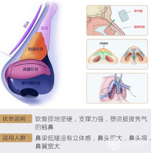 廣州荔灣人民醫(yī)院鼻子整形