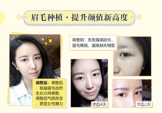 種植眉毛后的注意事項(xiàng)
