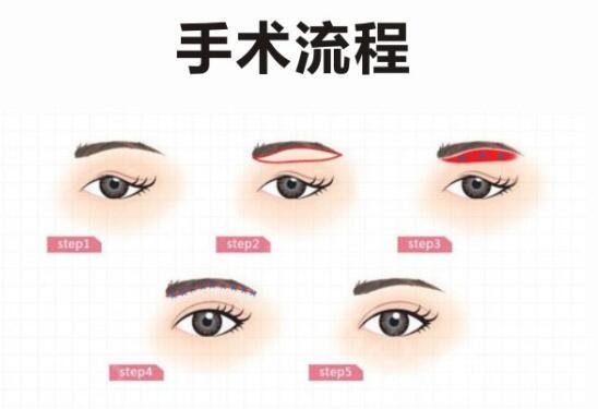 眉弓脂肪填充注意事項(xiàng)