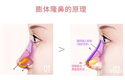 膨體隆鼻會變形嗎?