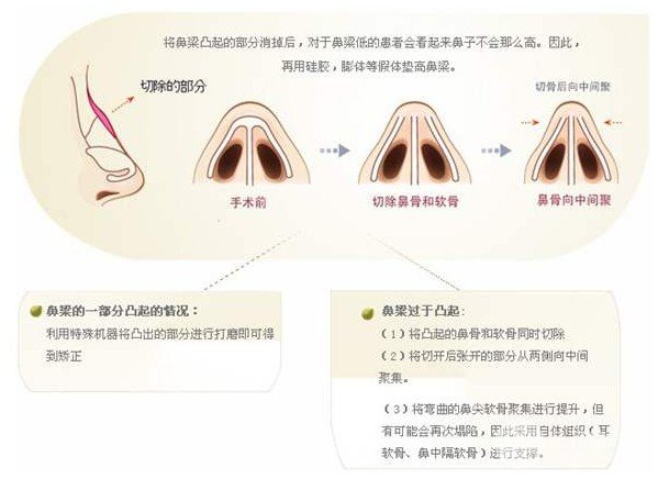 駝峰鼻修復(fù)精油