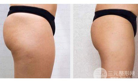 吸脂瘦臀多久才能恢復(fù)