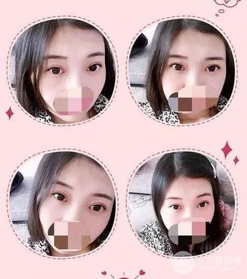 新星靚劉風(fēng)卓眼修復(fù)