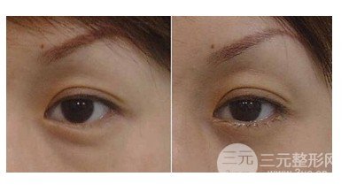 抽脂去眼袋手術(shù)利弊