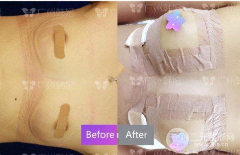 自體脂肪移植豐胸手術