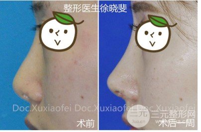 假體隆鼻會變形嗎