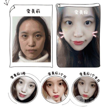 抽脂去除眼袋降低風(fēng)險(xiǎn)嗎