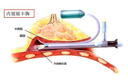 自體脂肪移植隆胸術的特點