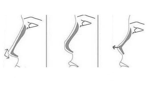 膨體隆鼻后取出