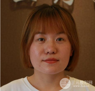 面部溶脂前后對比照片