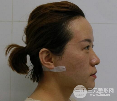 面部溶脂前后對比照片