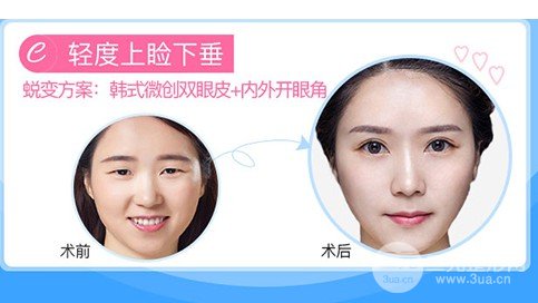 微創(chuàng)定點(diǎn)式好嗎