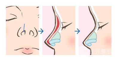 膨體隆鼻會變形嗎