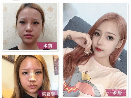 膨體隆鼻會變形嗎