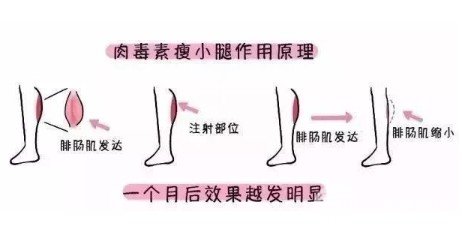 ****注射瘦腿降低風(fēng)險嗎